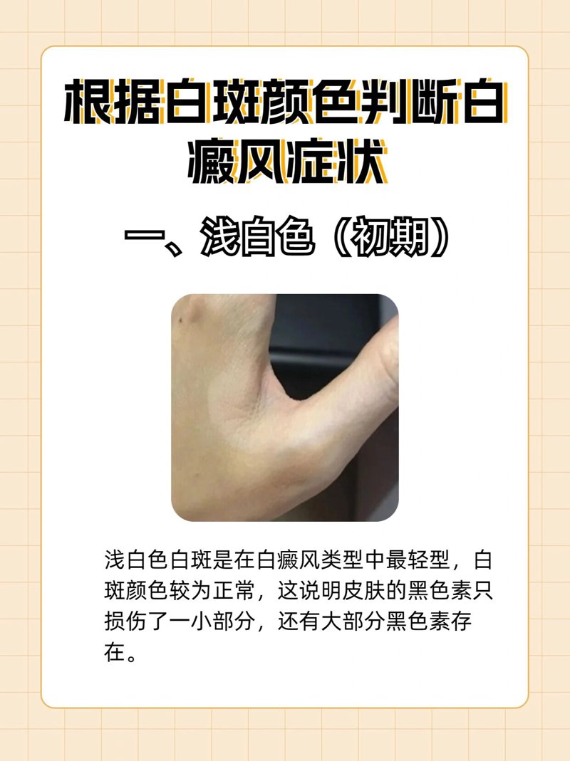合肥白癜风专科：2026年公立vs民营，三步教你精准选择