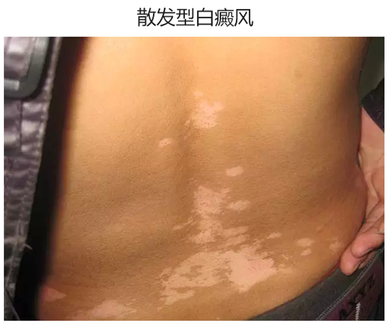 白癜风症状
